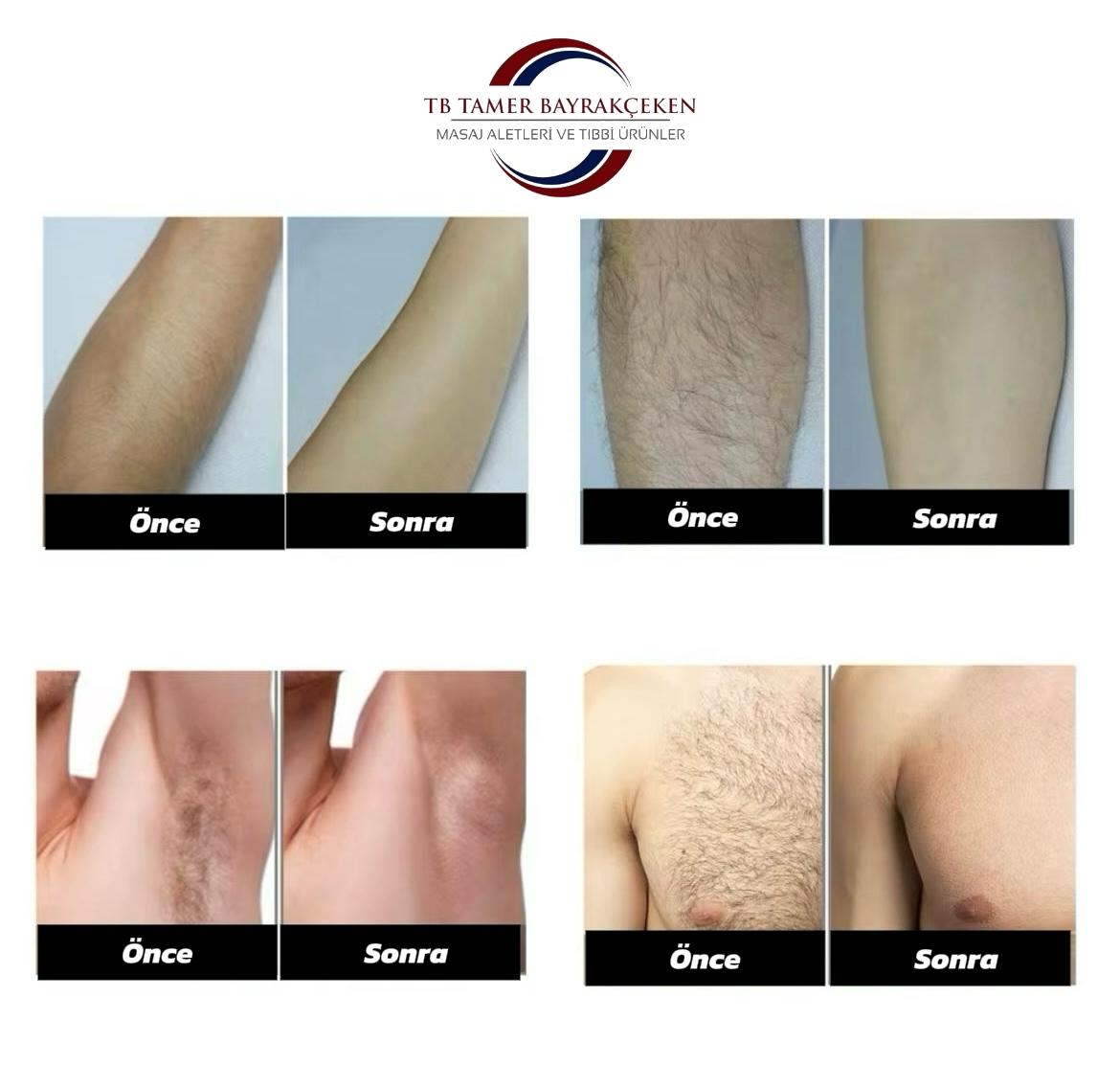 IPL Lazer Epilasyon Cihazı 990.000 Atım Manuel & Otomatik Mod – Acısız Kalıcı Tüy Giderme – 5 Seviye Işı